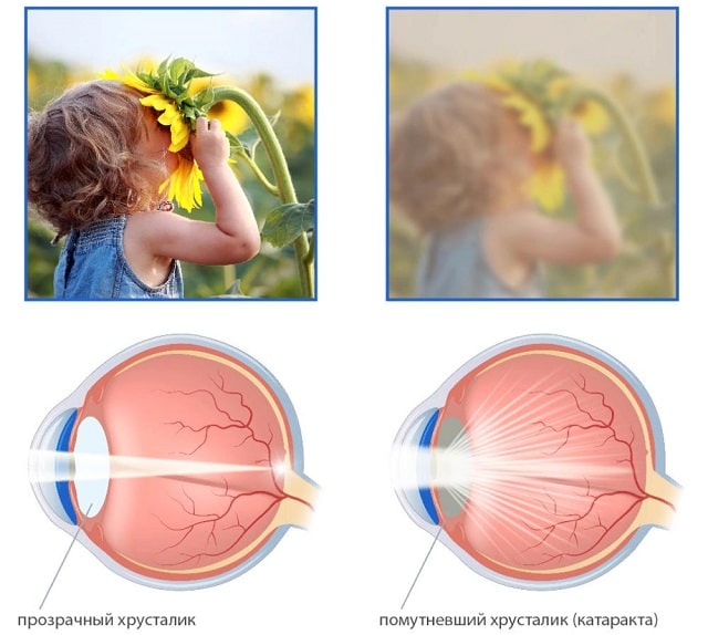Катаракта: что это за болезнь, симптомы и причины - фото4