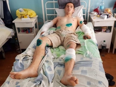 Под Харьковом мужчину покусали собаки: хозяин псов отделался 51 гривной штрафа