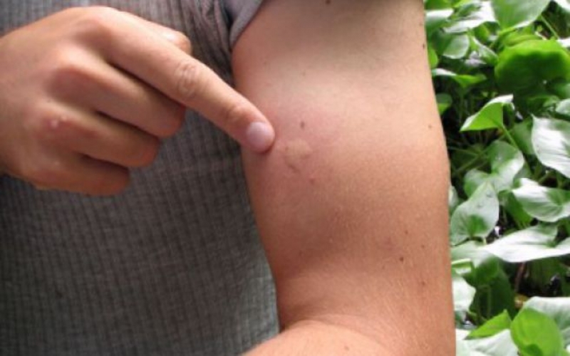 В Харькове снова зафиксировали завозной случай опасного недуга