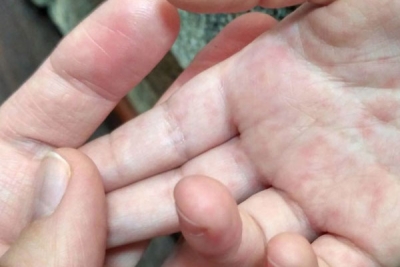 Харьковщина лидирует по количеству заболевших корью в течение минувшей недели