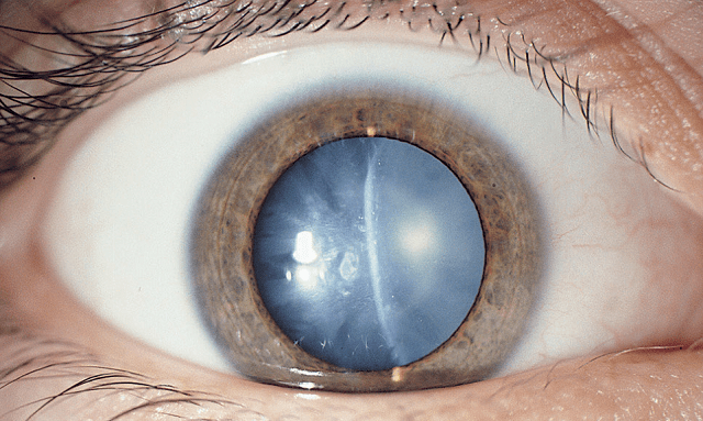 Катаракта: что это за болезнь, симптомы и причины