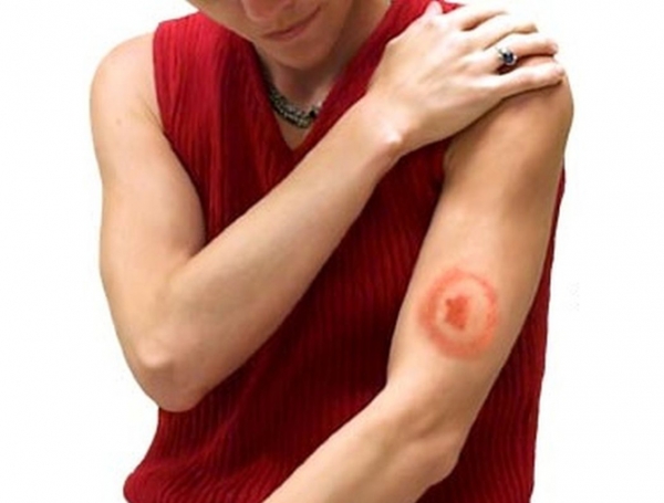 Болезнь Лайма угрожает харьковчанам