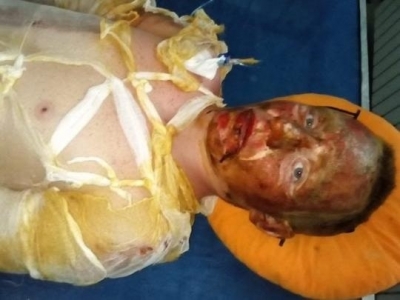 Вытащил из огня дедушку: харьковские медики борются за жизнь юного героя из Луганской области