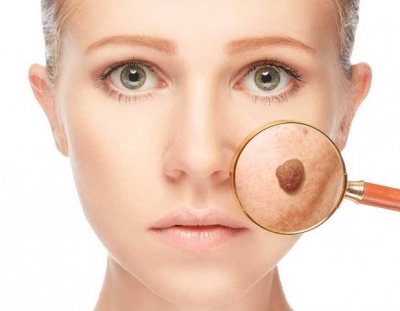 Лазерное удаление бородавок на лице: как работает, плюсы и минусы