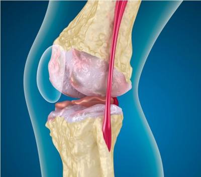 Артроз колінного суглоба: діагностика та сучасні напрями лікування