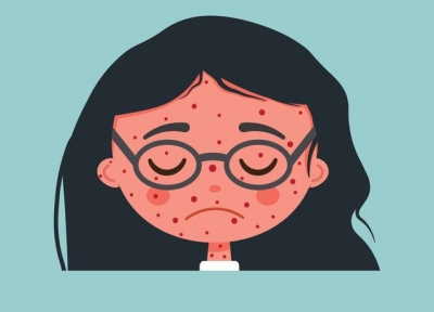 В Харьковской области резко возросла заболеваемость корью