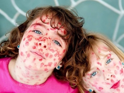 Корь не отступает: новые случаи опасного заболевания