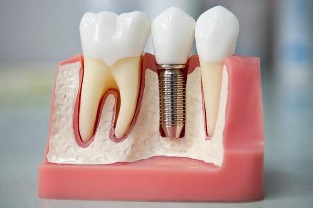 Имплантация зубов: этапы установки, сроки, плюсы и минусы
