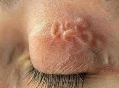 У харьковчанки из-под века глаза удалили длинного паразита