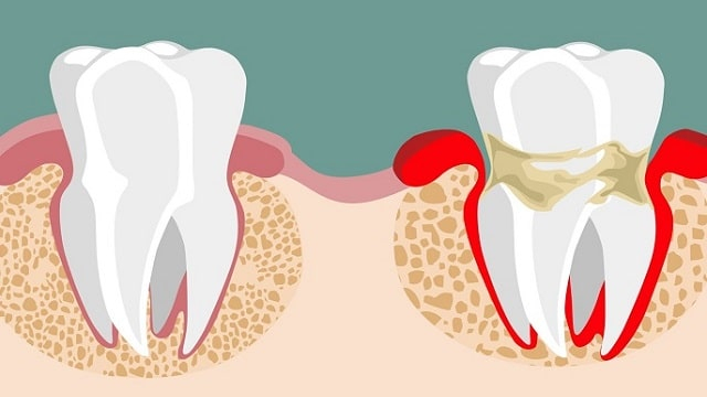 Пародонтоз: что это такое, причины, симптомы, профилактика