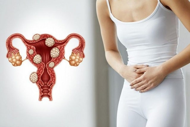 Миома матки: что это такое, виды, симптомы и причины