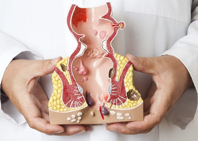 Геморрой: что это за заболевание, причины, симптомы, профилактика