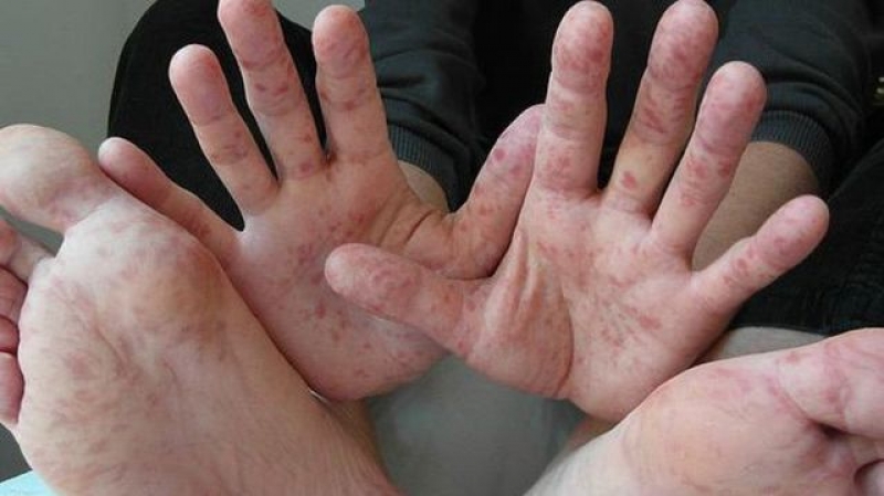 На Харьковщине зафиксирована новая жертва опасного заболевания