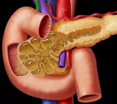 Панкреатит: что это за болезнь, причины, профилактика