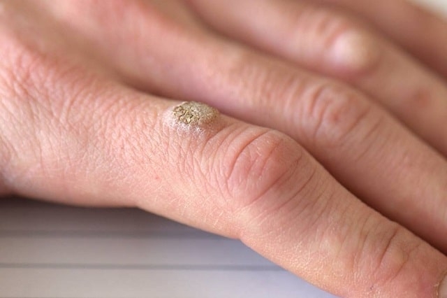 Бородавки: что это такое, причины, профилактика