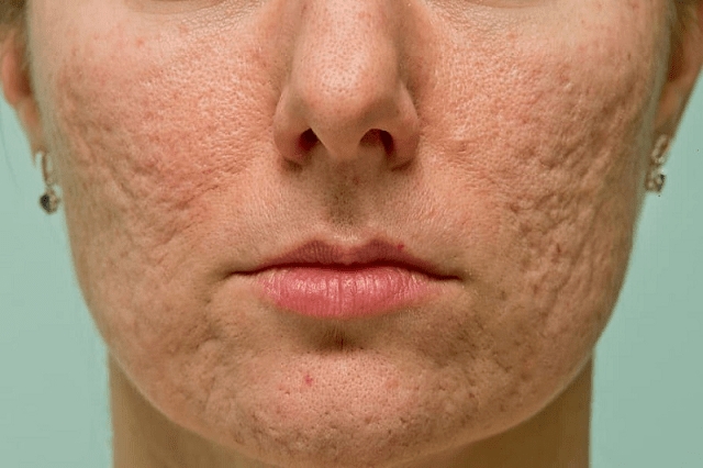 Как избавиться от шрамов от угревой сыпи: мнение дерматолога