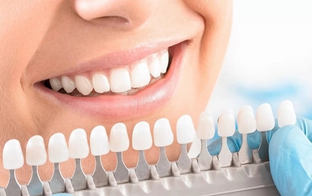 Отбеливание зубов: виды, методики, противопоказания