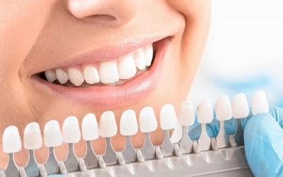 Отбеливание зубов: виды, методики, противопоказания