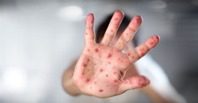 В облэнерго, АТБ, ВУЗах и больницах: на Харьковщине зарегистрировано 35 вспышек кори