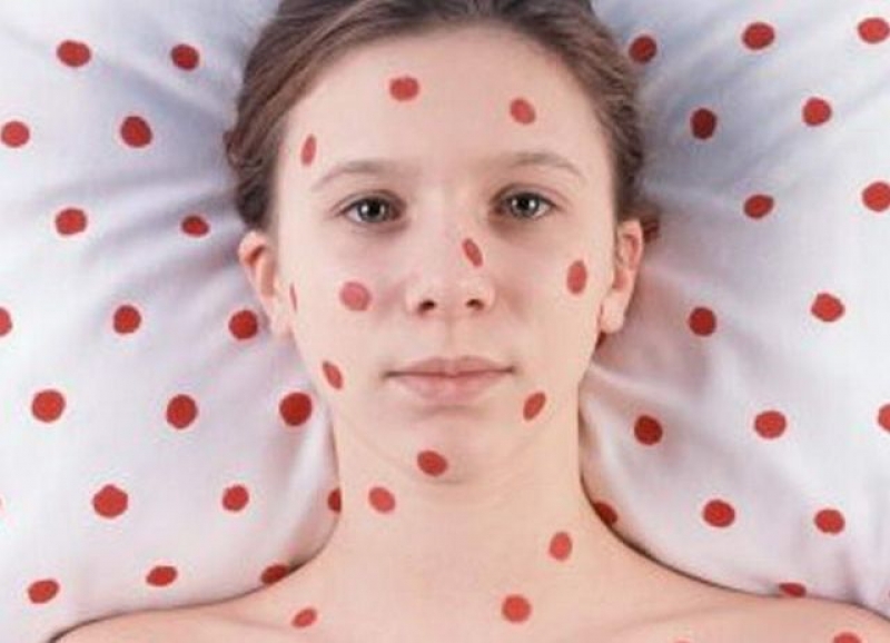 На Харьковщине зафиксировали новый случай кори