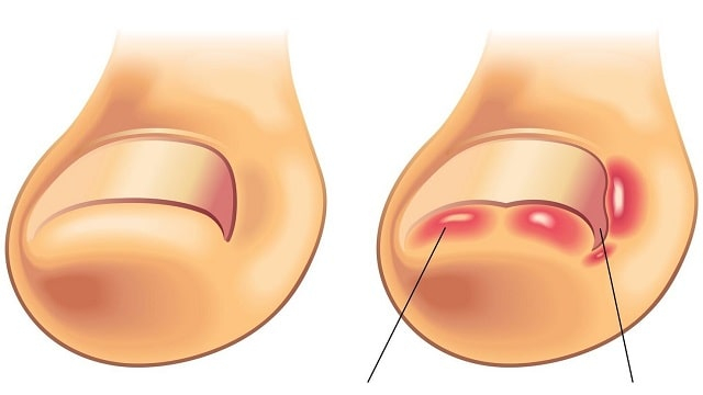 Вросший ноготь: причины появления, что делать, профилактика