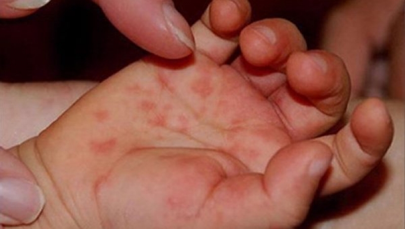 По Харьковской области стремительно расползается опасный недуг