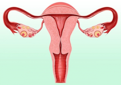 Эндометриоз матки: что это такое, понятное объяснение