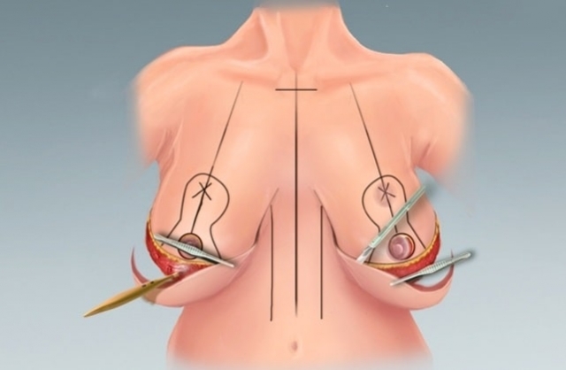 На сколько размеров вы можете уменьшить грудь