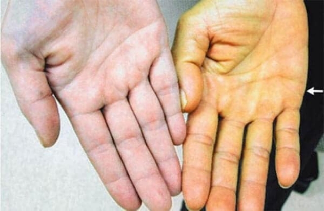 Острый вирусный гепатит А обнаружен у несовершеннолетних