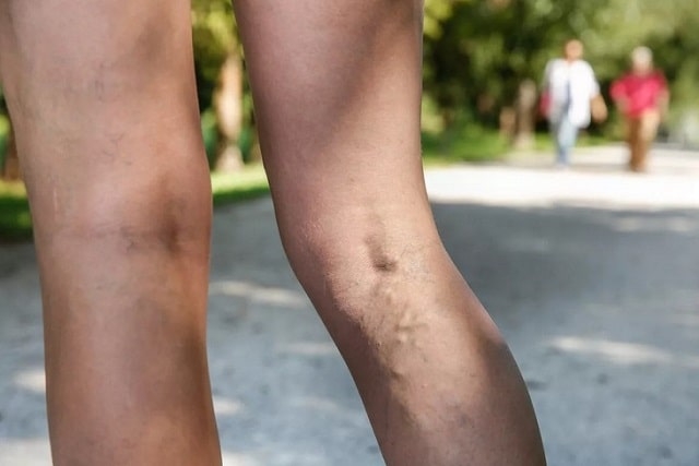 Варикоз: что это такое (симптомы, причины, профилактика)