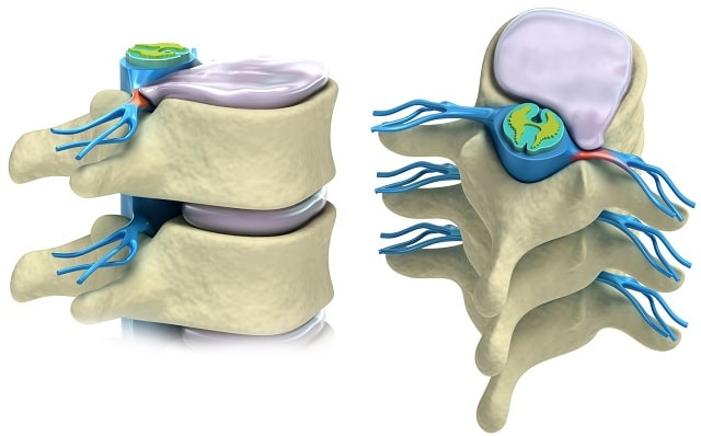 Протрузия дисков позвоночника: что это такое, симптомы, профилактика