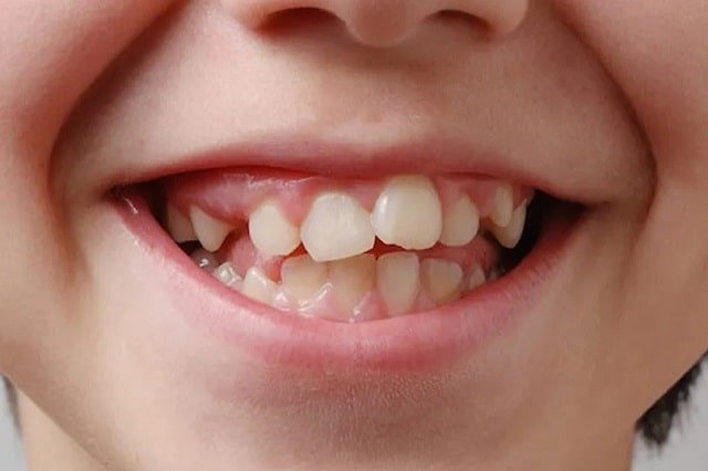 Ретенция зуба: что такое, причины и последствия