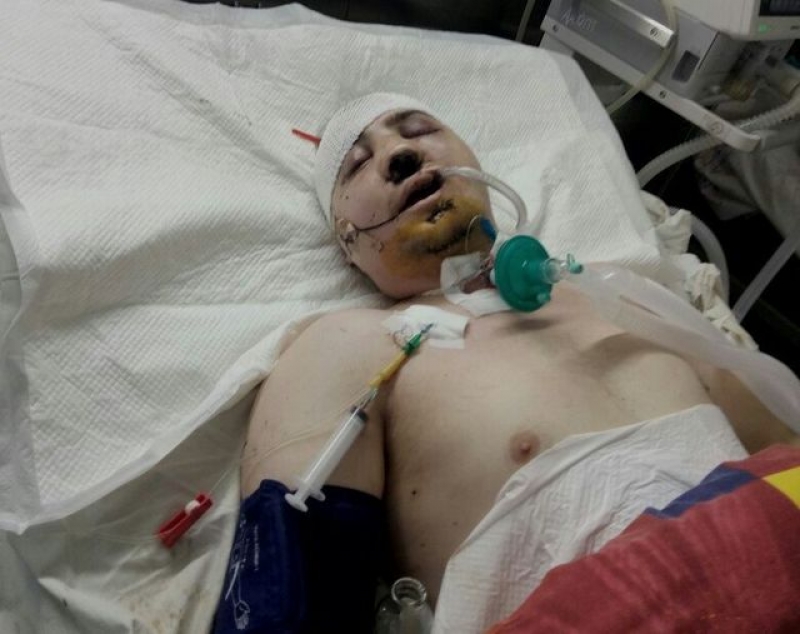 Харьковчанин, выпавший из окна 8 этажа, борется за жизнь