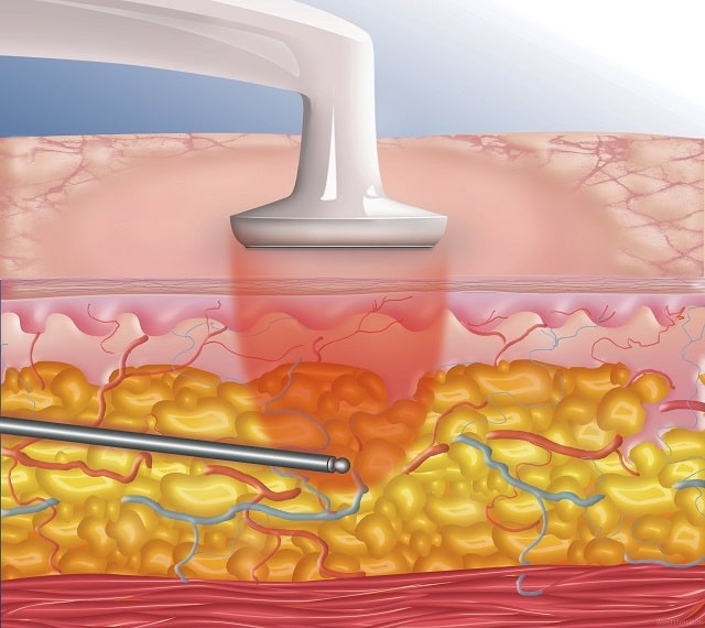 Липосакция: что это такое, виды, как проходит