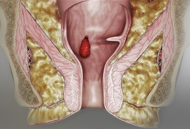 Основні симптоми геморою: як вчасно визначити хворобу