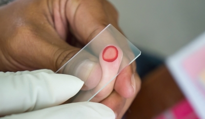 Житель Ганы «привез» малярию