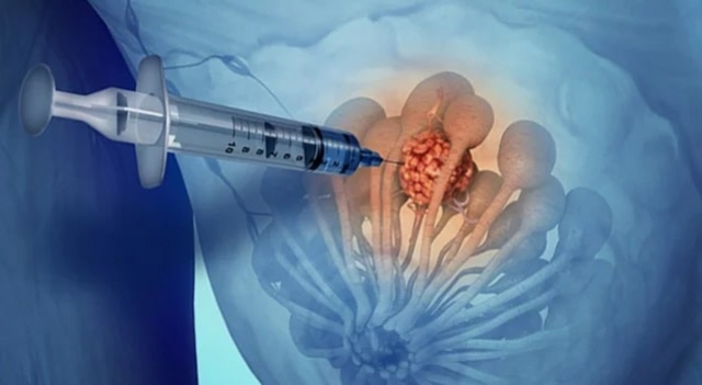 Біопсія молочної залози: навіщо вона потрібна