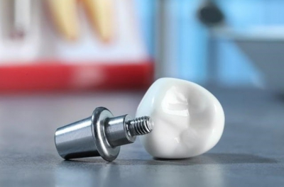 Что такое абатменты и почему они так важны в имплантологии зубов?