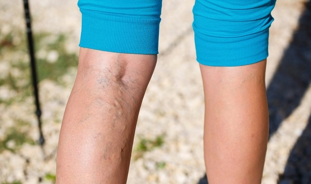 Лечение варикоза: особенности, правила