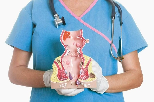 Как защититься от геморроя: причины возникновения и профилактика заболевания