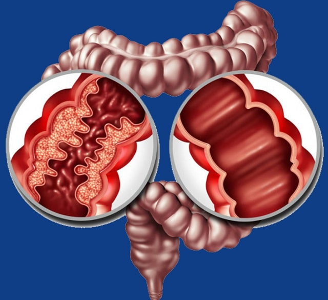 Болезнь Крона: что это такое, симптомы, профилактика