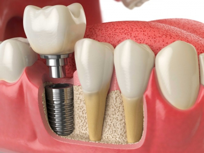 Имплантация зубов: что это такое, как происходит, плюсы и минусы